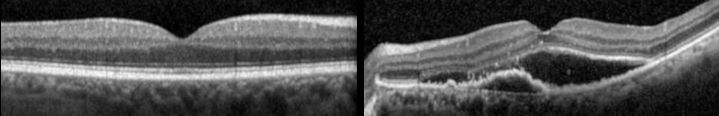 Aspect en OCT : à gauche une rétine normale, à droite lors d'une DMLA exsudative.